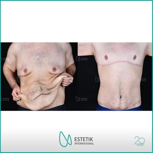 Traitement de la Gynécomastie (avec liposuccion) Photos avant & après